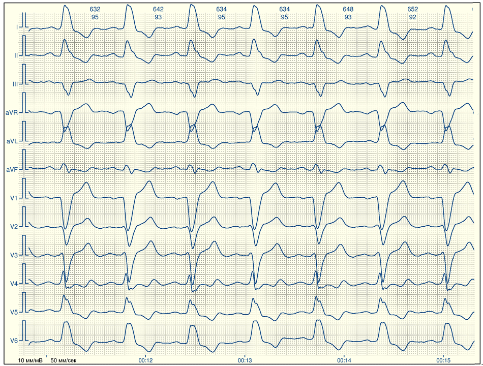 Полная блокада ножки. Полная блокада левой ножки пучка Гиса на ЭКГ. Блокада левой ножки пучка Гиса на ЭКГ. Полная блокада пучка Гиса на ЭКГ. Блокада ножек пучка Гиса на ЭКГ.