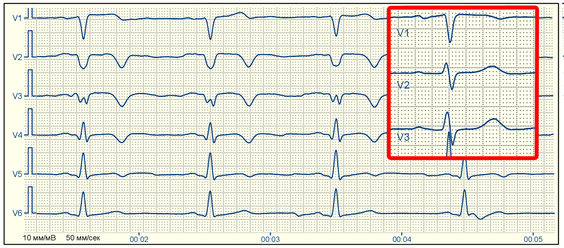 Изменение передней стенки левого желудочка. Инфаркт миокарда v1-v3 ЭКГ. Рубец инфаркт миокарда ЭКГ. Рубцовые изменения миокарда на ЭКГ. Рубец инфаркта на ЭКГ.