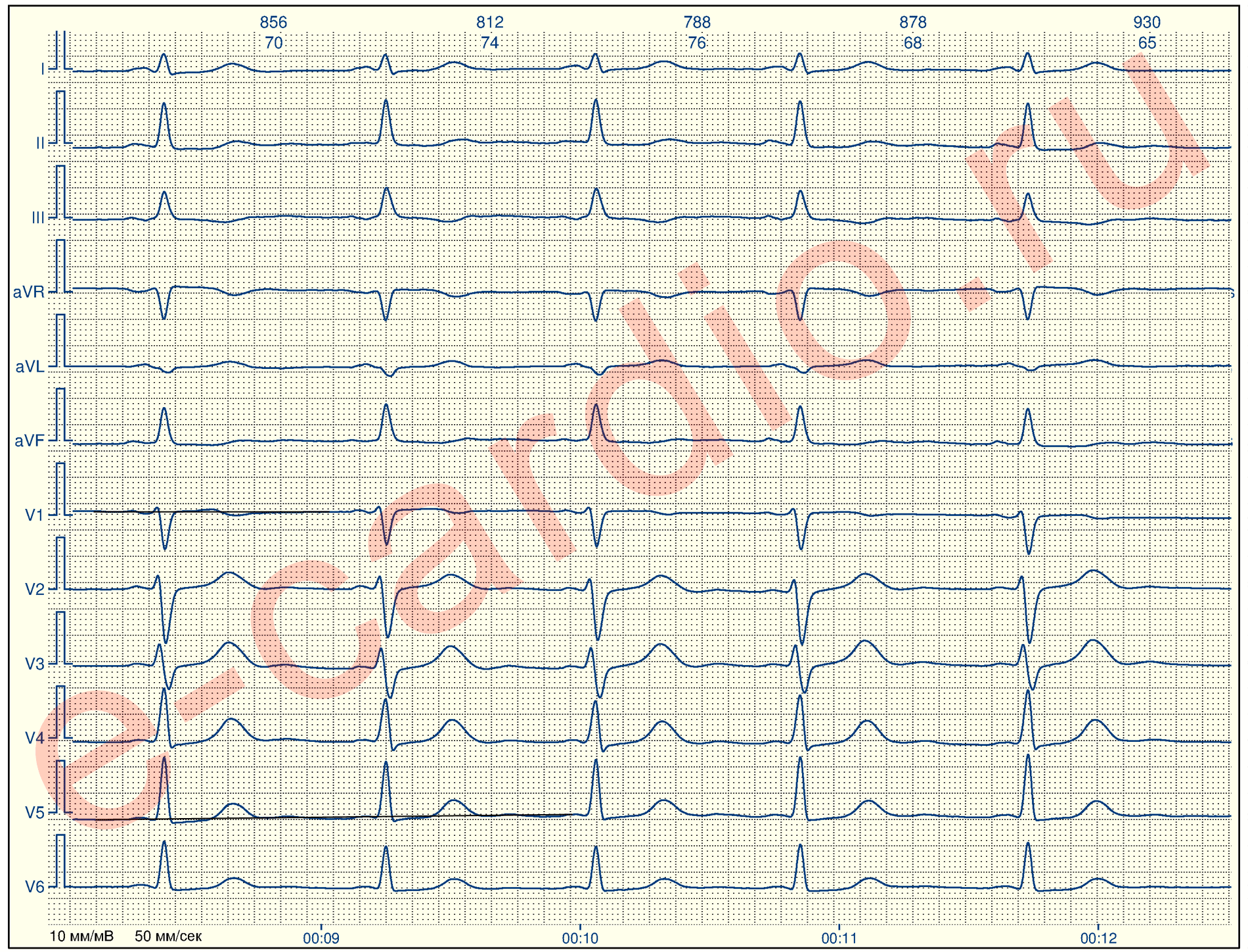Перегрузка на экг что это. Индекс Соколова-Лайона на ЭКГ. Гипертрофия левого желудочка на ЭКГ индекс Соколова. Корнельское произведение ЭКГ. Корнельский вольтажный индекс на ЭКГ.