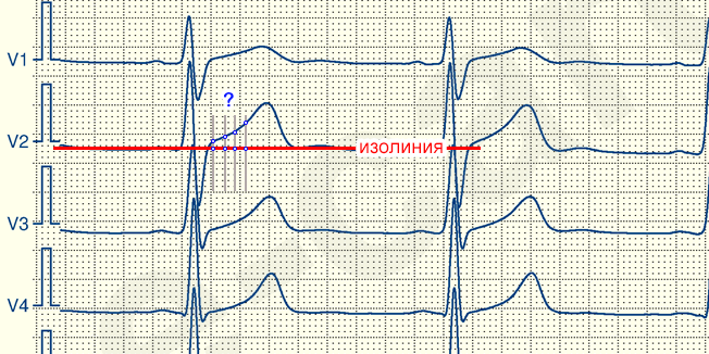 Экг при инфаркте миокарда с элевацией сегмента st