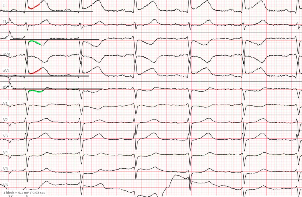 Инфаркт миокарда снижение сегмента st