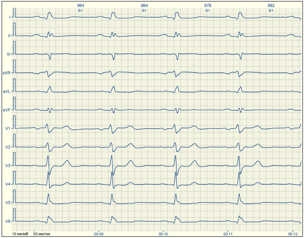 Расшифровка ЭКГ для чайников с примерами - E-Cardio